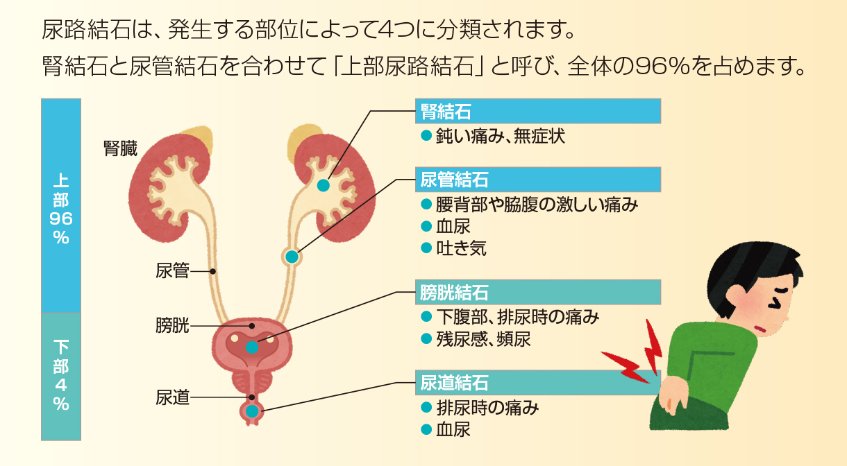 腎結石：鈍い痛み、無症状／尿管結石：腰背部や脇腹の激しい痛み、血尿、吐き気／膀胱結石：下腹部、排尿時の痛み、残尿感、頻尿／尿道結石：排尿時の痛み、血尿