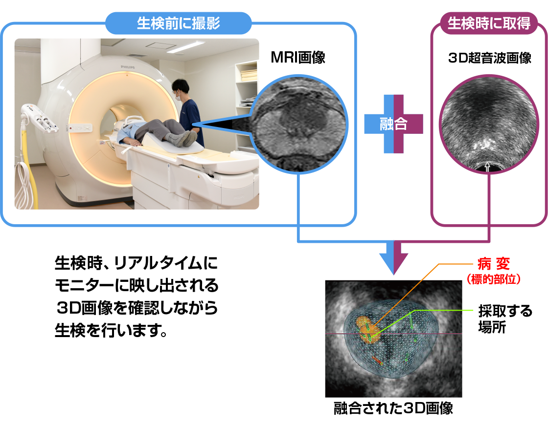 トリニティによる標的生検イメージ図