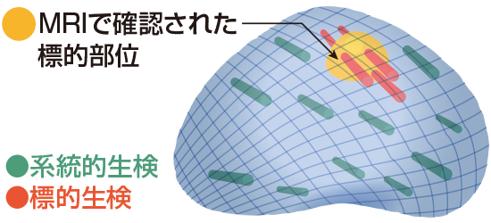 トリニティによる経直腸標的生検のイメージ