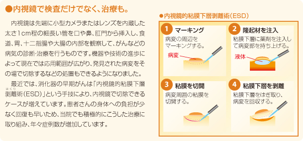 内視鏡で検査だけでなく、治療も。内視鏡的粘膜下層剥離術(ESD)